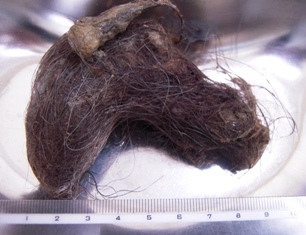 卵巣 嚢腫 髪の毛